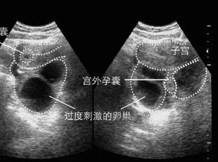 2026年没有卵泡去温州市人民医院做三代试管贵吗？具体费用明细参考